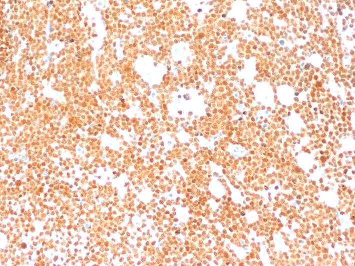 third bone marrow biopsy PAX 5